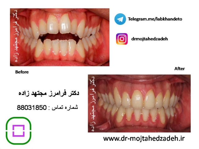 عکس های قبل و بعد از درمان