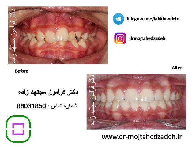 عکس های قبل و بعد از درمان