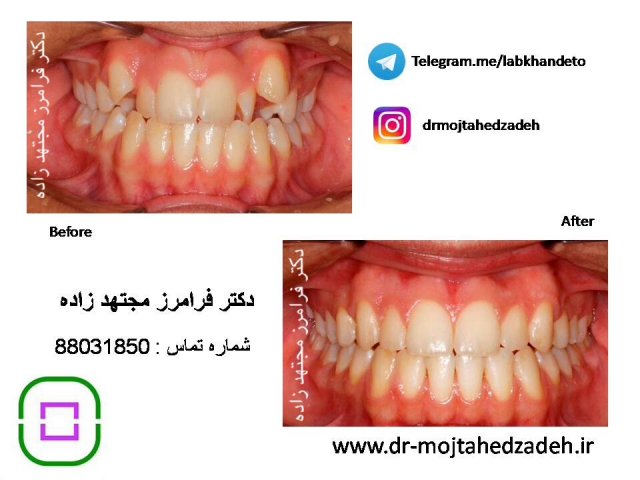 عکس های قبل و بعد از درمان