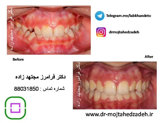 عکس های قبل و بعد از درمان