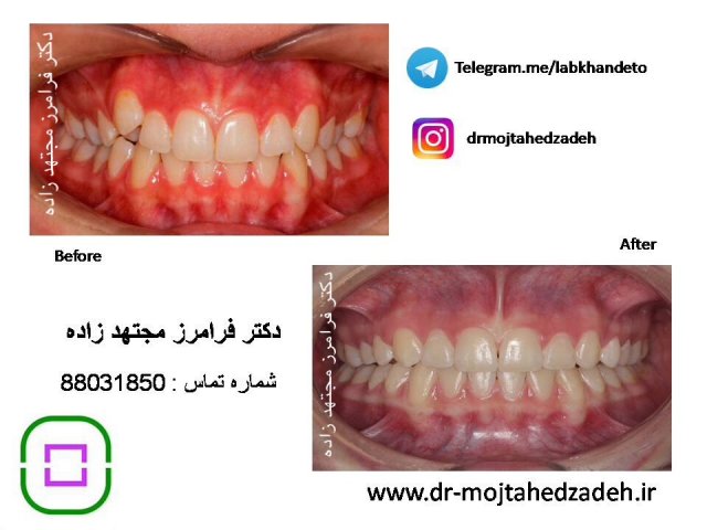 عکس های قبل و بعد از درمان