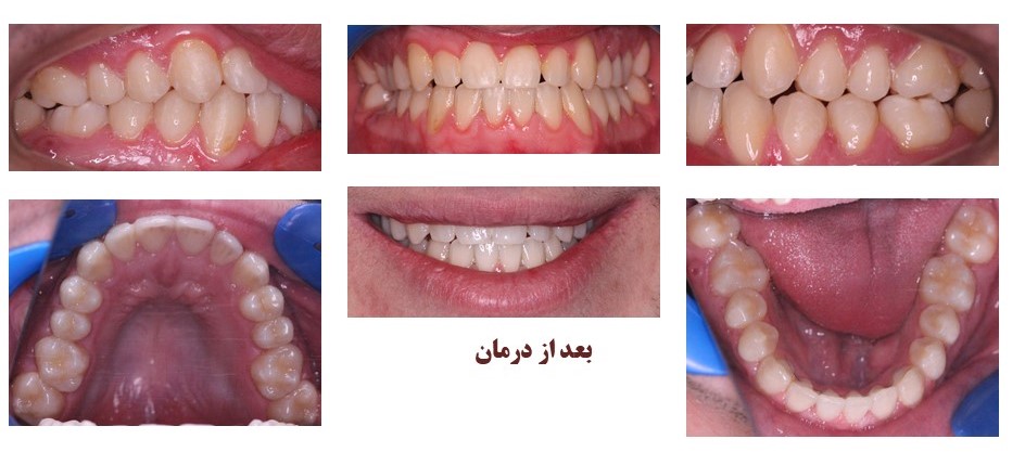 تصاویر قبل و بعد از بیمارانی که با کمک میکروایمپلنت درمان شده اند
